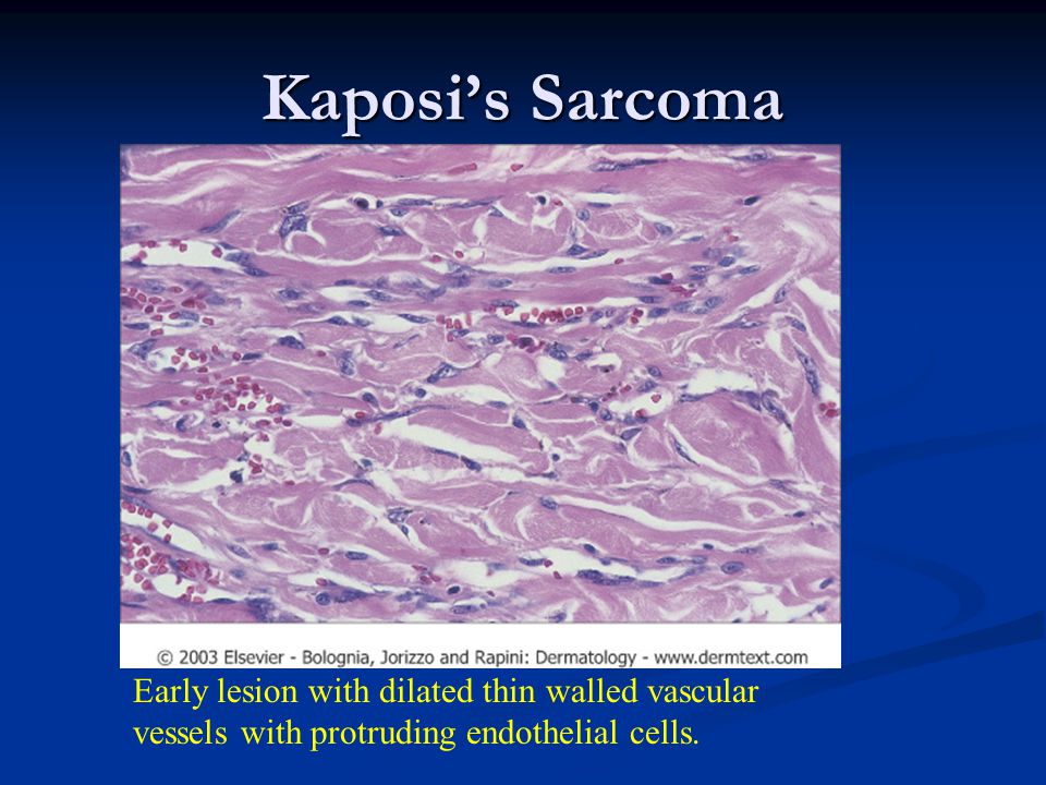 Kaposi’s Sarcoma Early lesion with dilated thin walled vascular vessels with protruding endothelial cells.