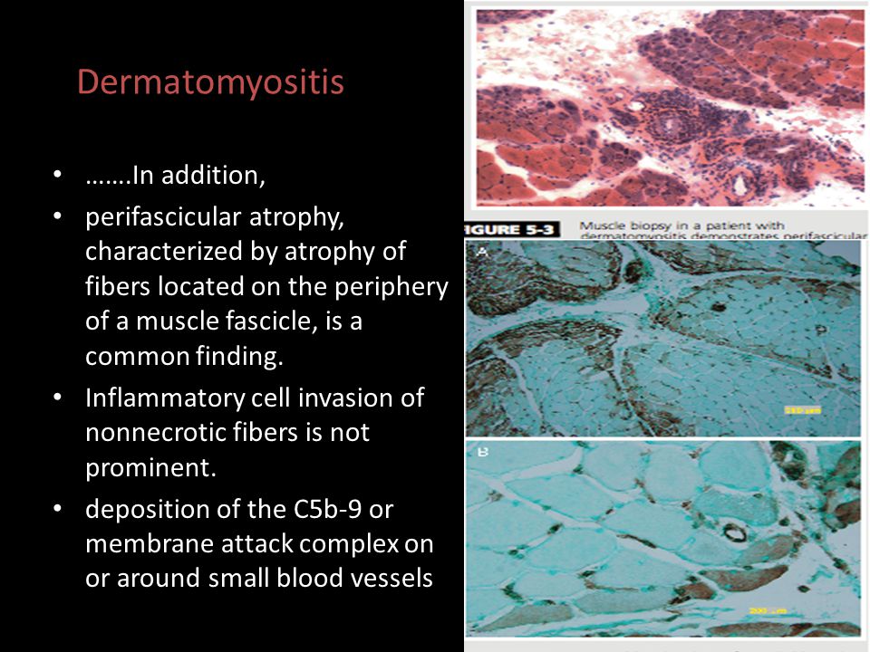 Dermatomyositis …….In addition,