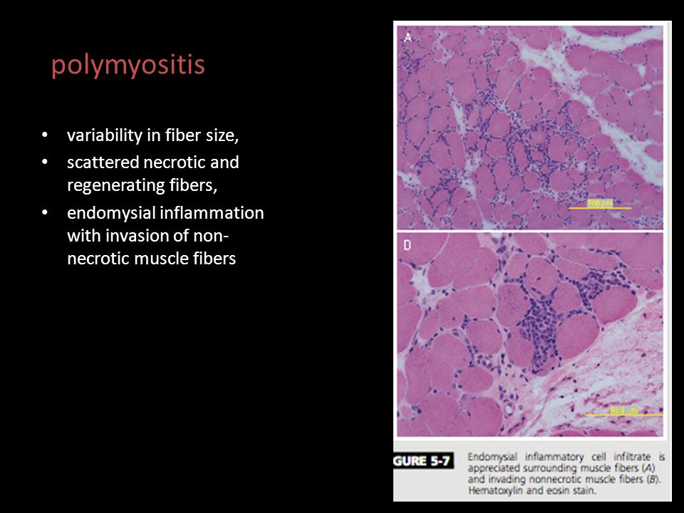 polymyositis variability in fiber size,