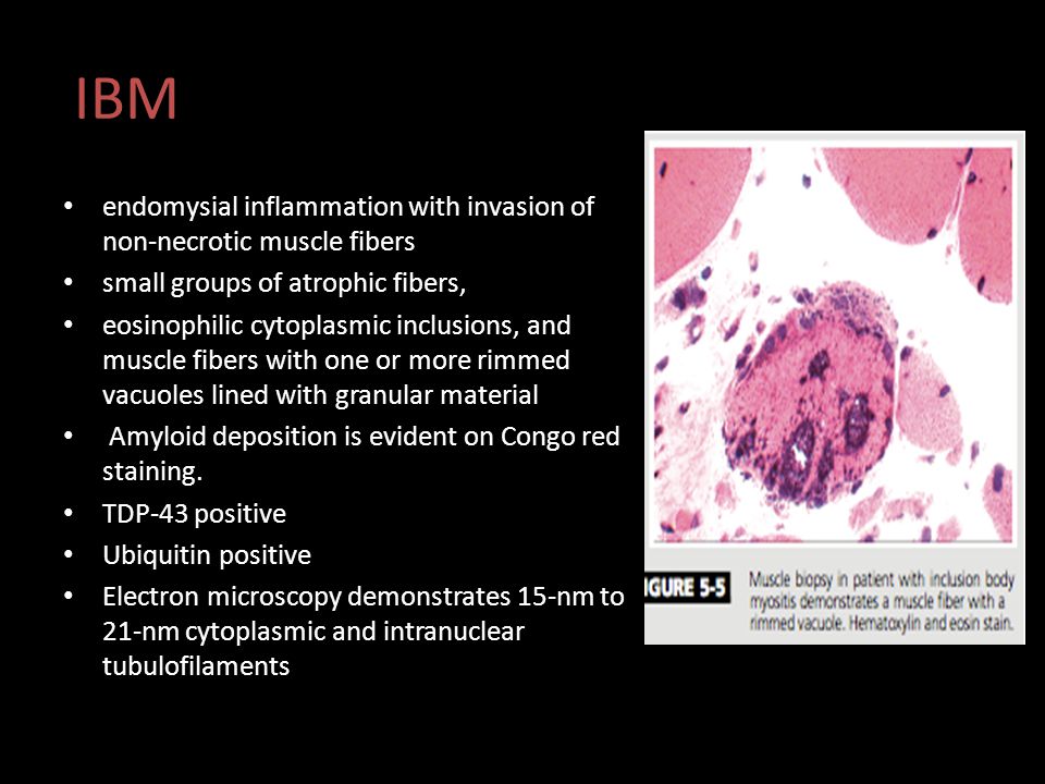 IBM endomysial inflammation with invasion of non-necrotic muscle fibers. small groups of atrophic fibers,