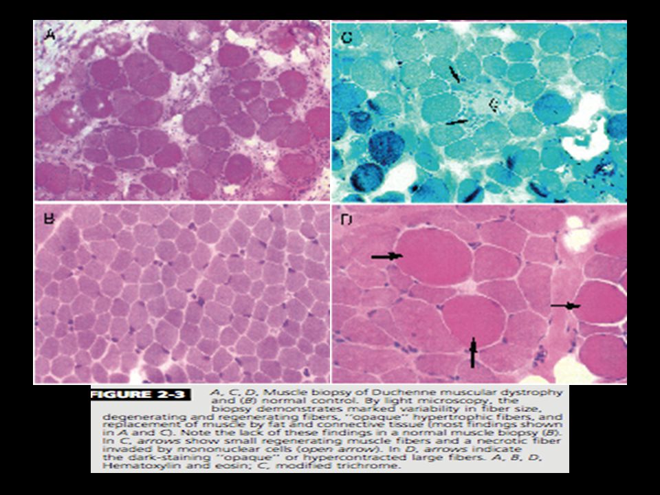 A, C, D, Muscle biopsy of Duchenne muscular dystrophy and (B) normal control.