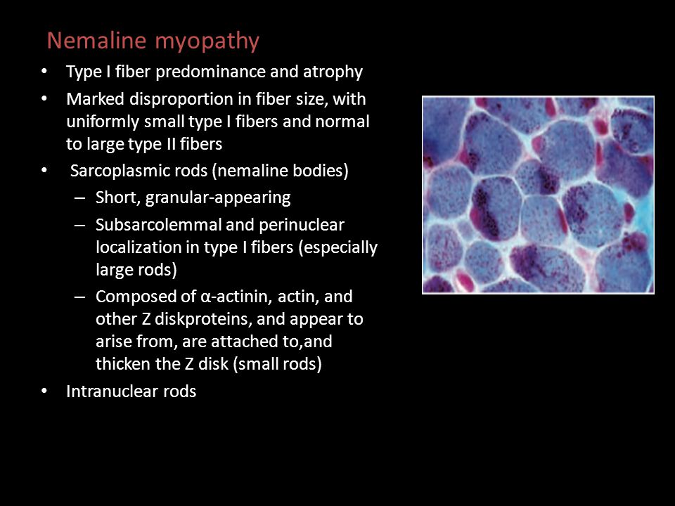 Nemaline myopathy Type I fiber predominance and atrophy