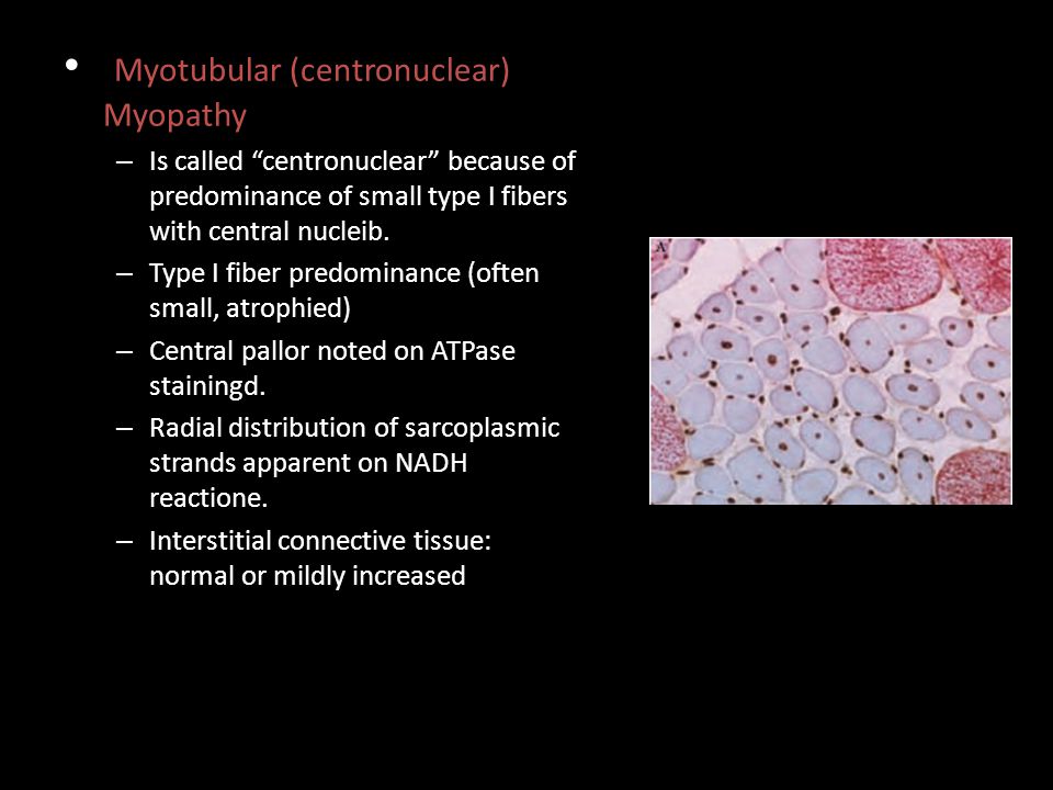 Myotubular (centronuclear) Myopathy