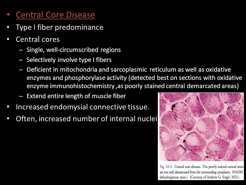Central Core Disease Type I fiber predominance Central cores