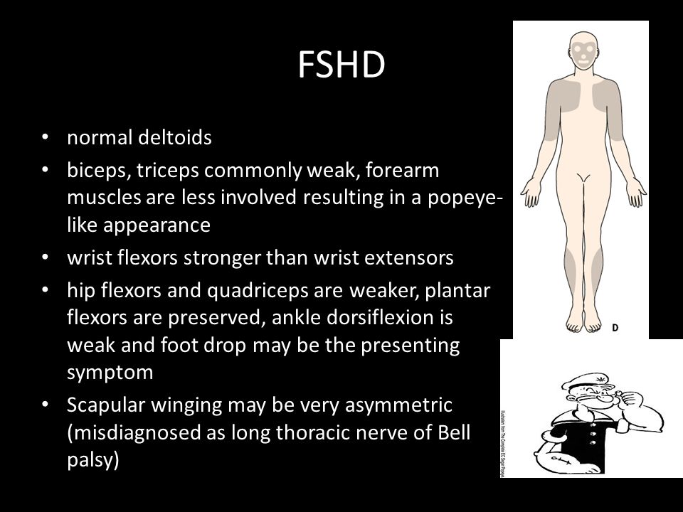 FSHD normal deltoids. biceps, triceps commonly weak, forearm muscles are less involved resulting in a popeye-like appearance.