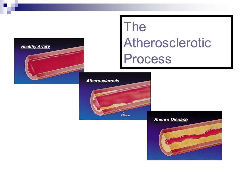 The Atherosclerotic Process