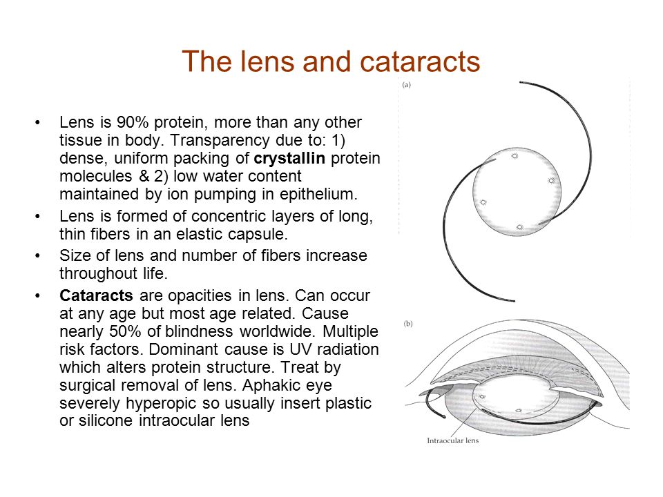 The lens and cataracts