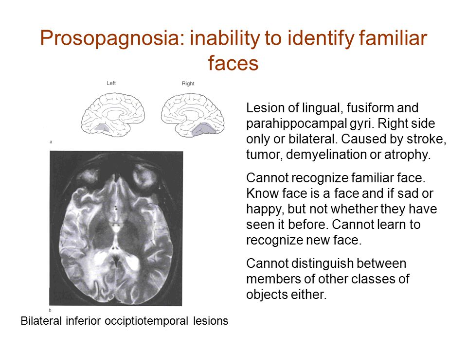 Prosopagnosia: inability to identify familiar faces