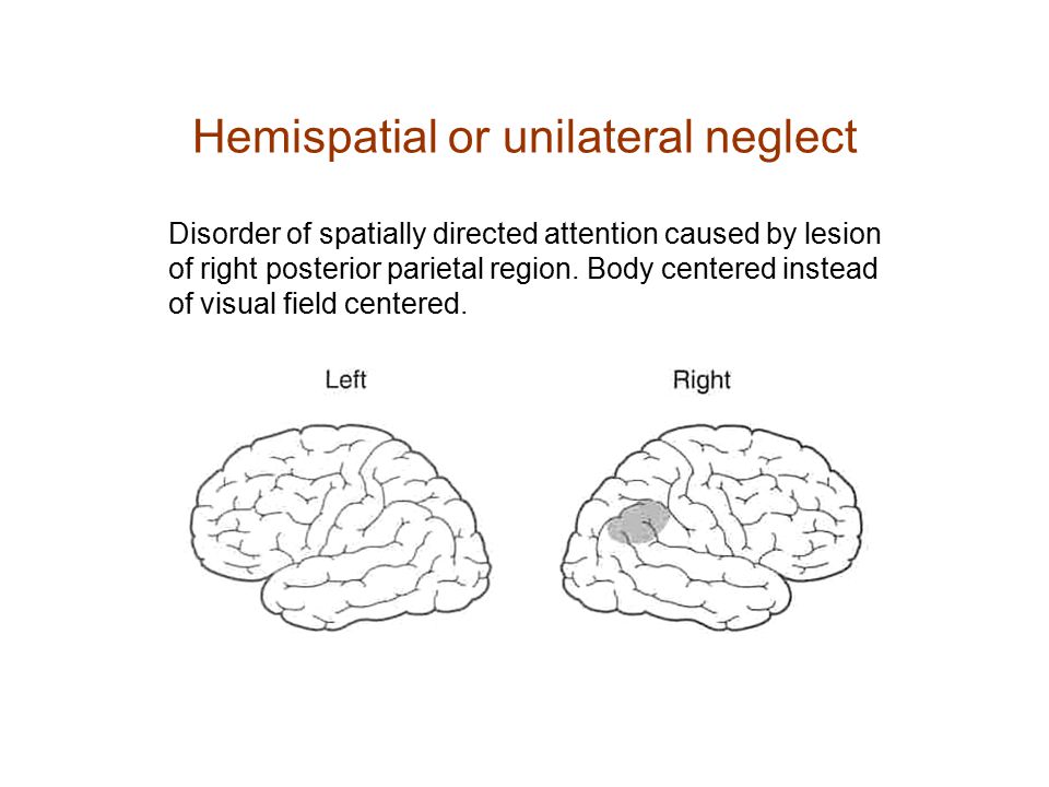 Hemispatial or unilateral neglect