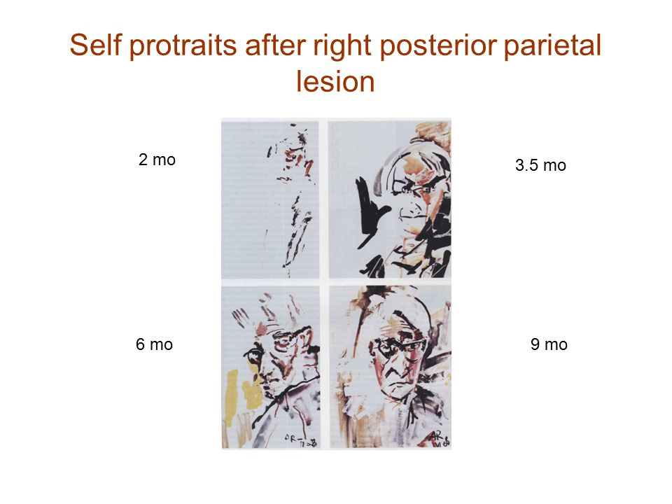 Self protraits after right posterior parietal lesion
