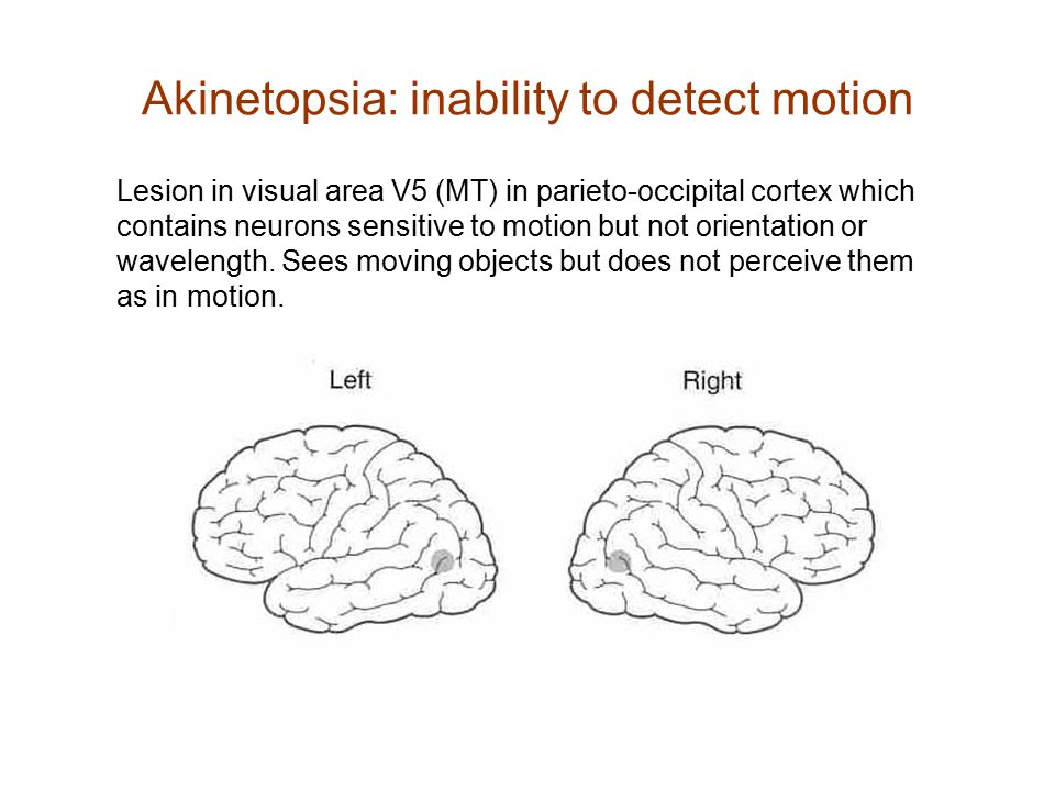 Akinetopsia: inability to detect motion