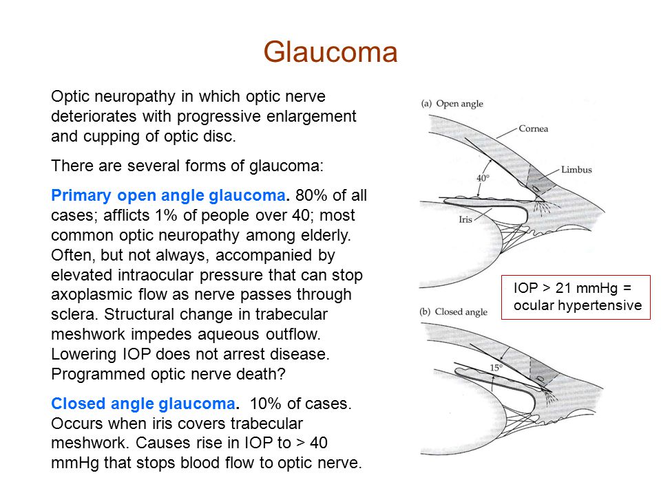 Glaucoma Optic neuropathy in which optic nerve deteriorates with progressive enlargement and cupping of optic disc.