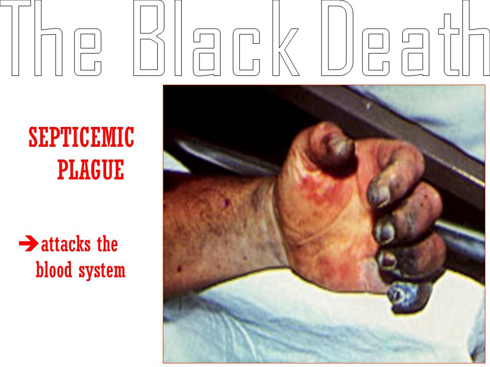 The Black Death SEPTICEMIC PLAGUE attacks the blood system