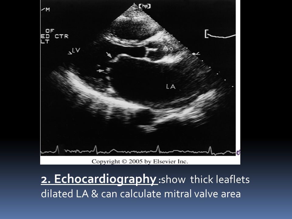 2. Echocardiography :show thick leaflets dilated LA & can calculate mitral valve area
