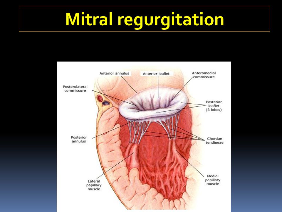 Mitral regurgitation
