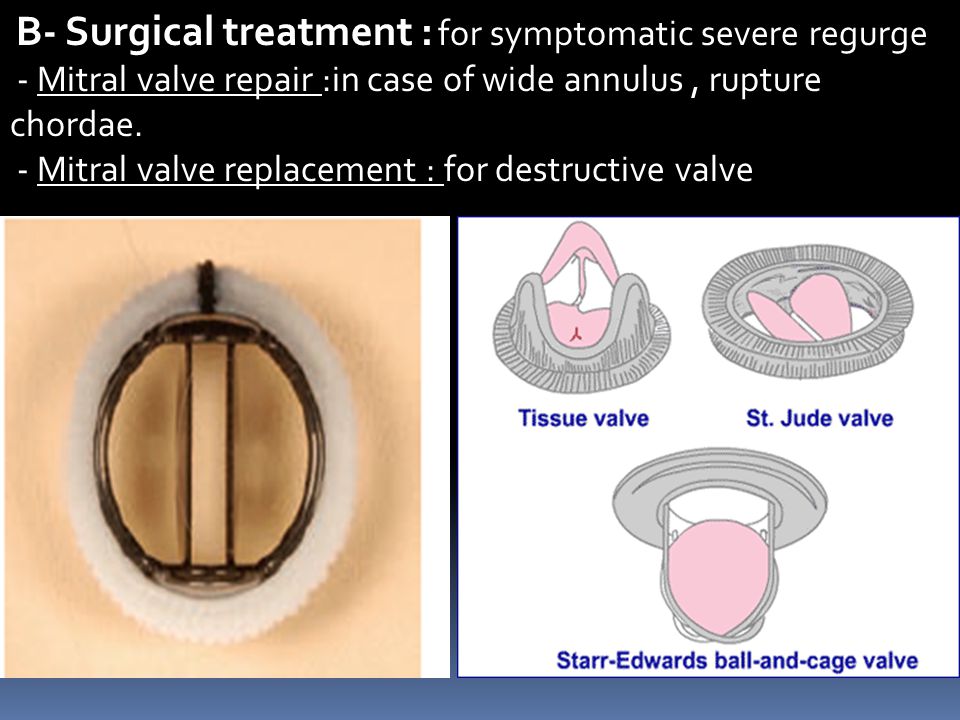 - Mitral valve repair :in case of wide annulus , rupture chordae.