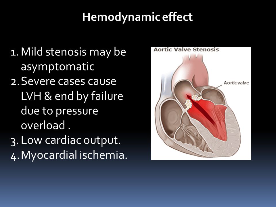 Hemodynamic effect Mild stenosis may be asymptomatic. Severe cases cause LVH & end by failure due to pressure overload .