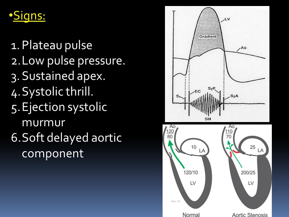 Signs: Plateau pulse. Low pulse pressure. Sustained apex. Systolic thrill. Ejection systolic murmur.
