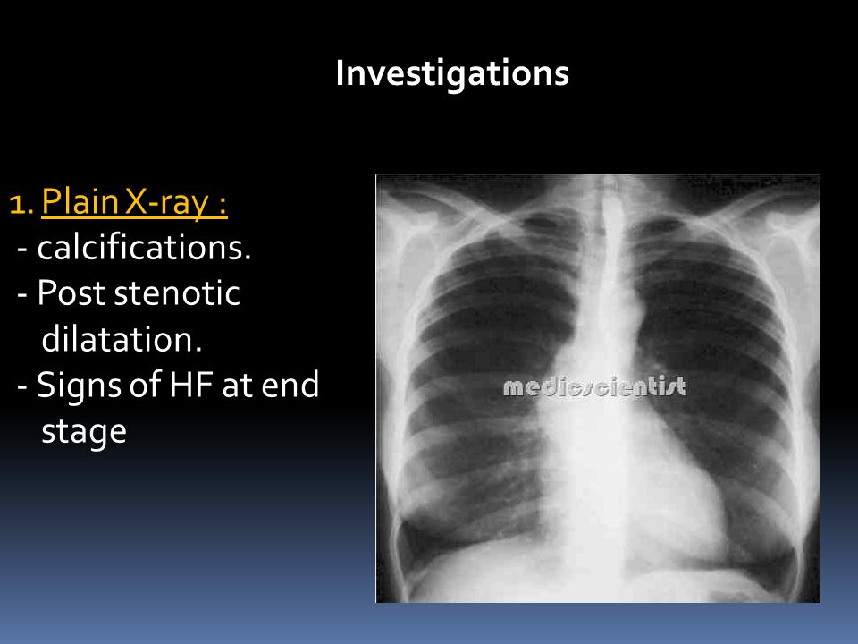 Investigations Plain X-ray : - calcifications. - Post stenotic dilatation.