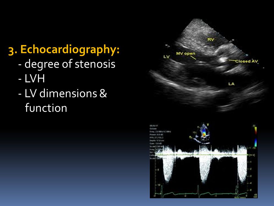 3. Echocardiography: - degree of stenosis - LVH - LV dimensions & function