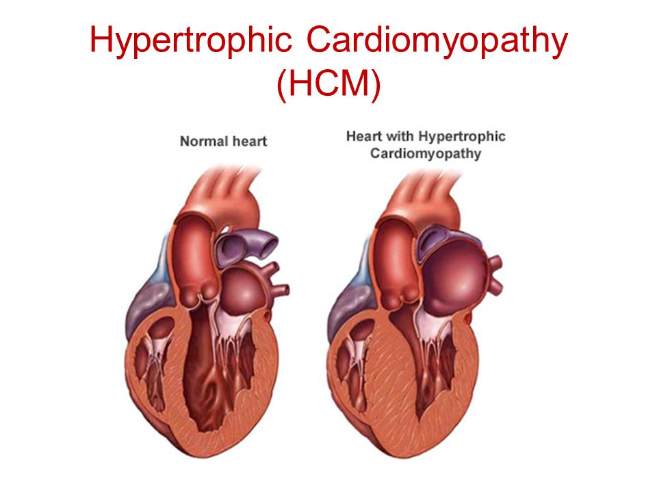 Hypertrophic+Cardiomyopathy+%28HCM%29.jpg