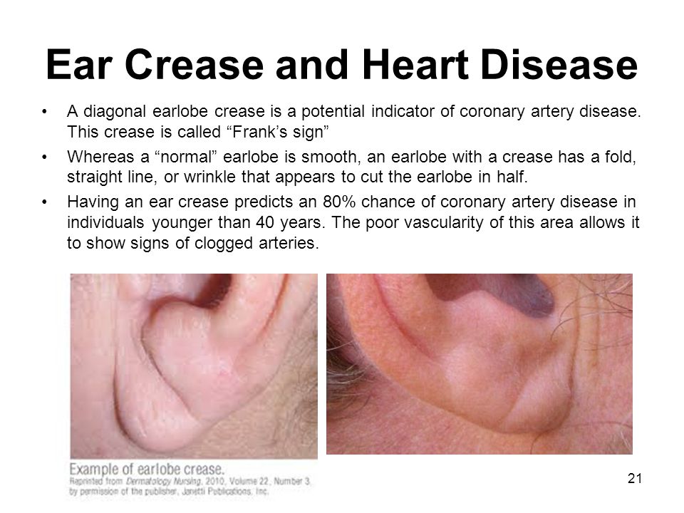 Ear+Crease+and+Heart+Disease.jpg