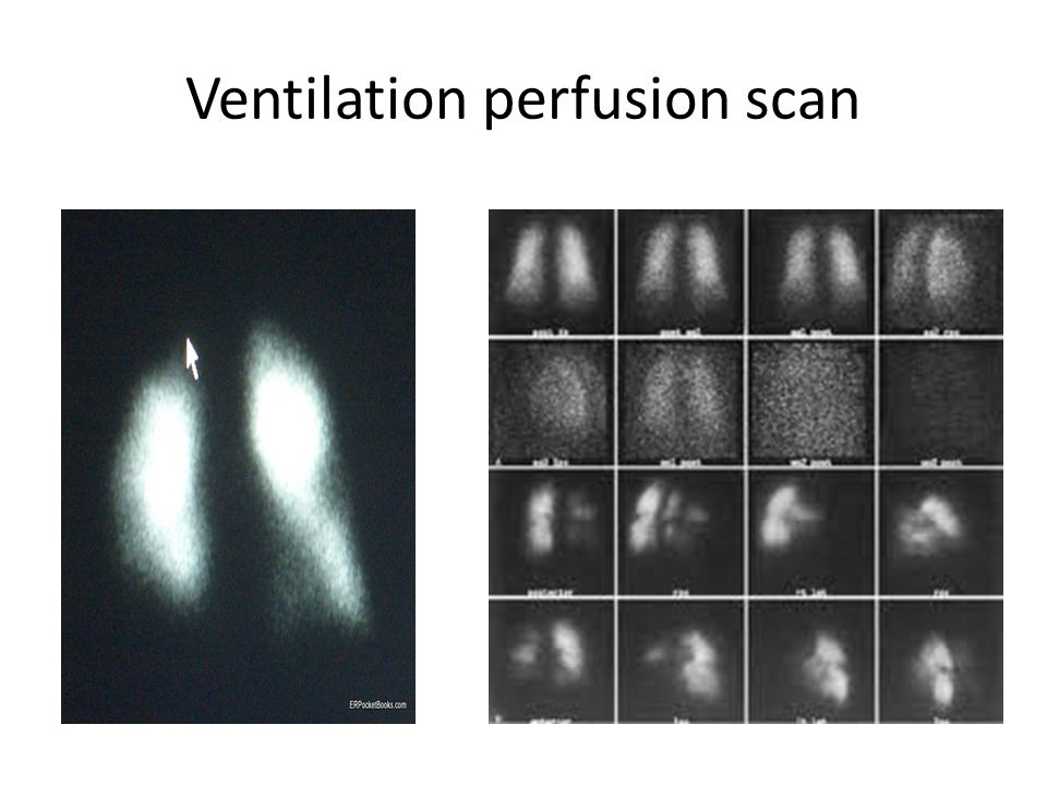 Ventilation perfusion scan