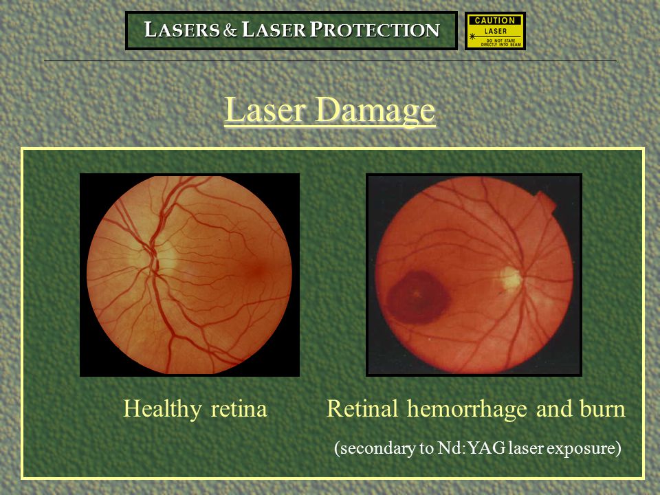 Laser+Damage+Healthy+retina+Retinal+hemorrhage+and+burn.jpg