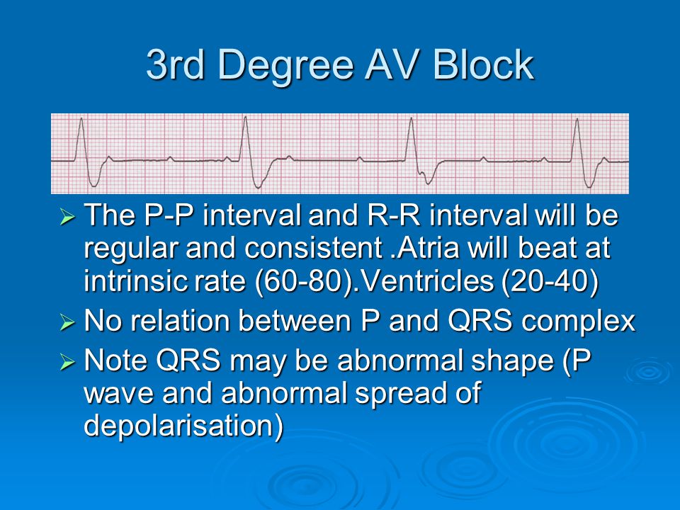 3rd Degree AV Block The P-P interval and R-R interval will be regular and consistent .Atria will beat at intrinsic rate (60-80).Ventricles (20-40)