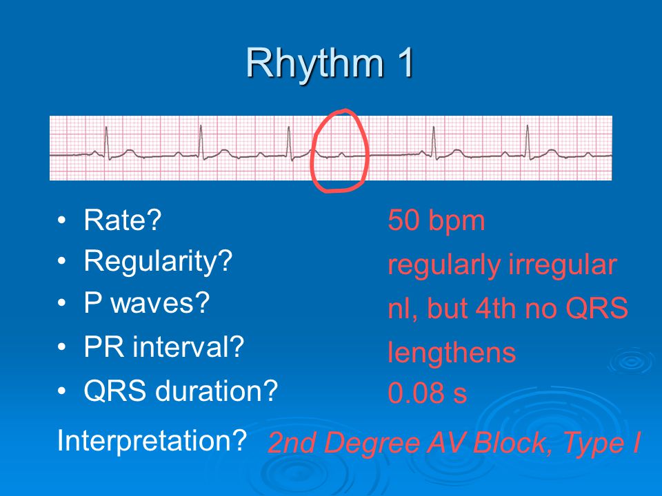 Rhythm 1 Rate 50 bpm Regularity regularly irregular P waves