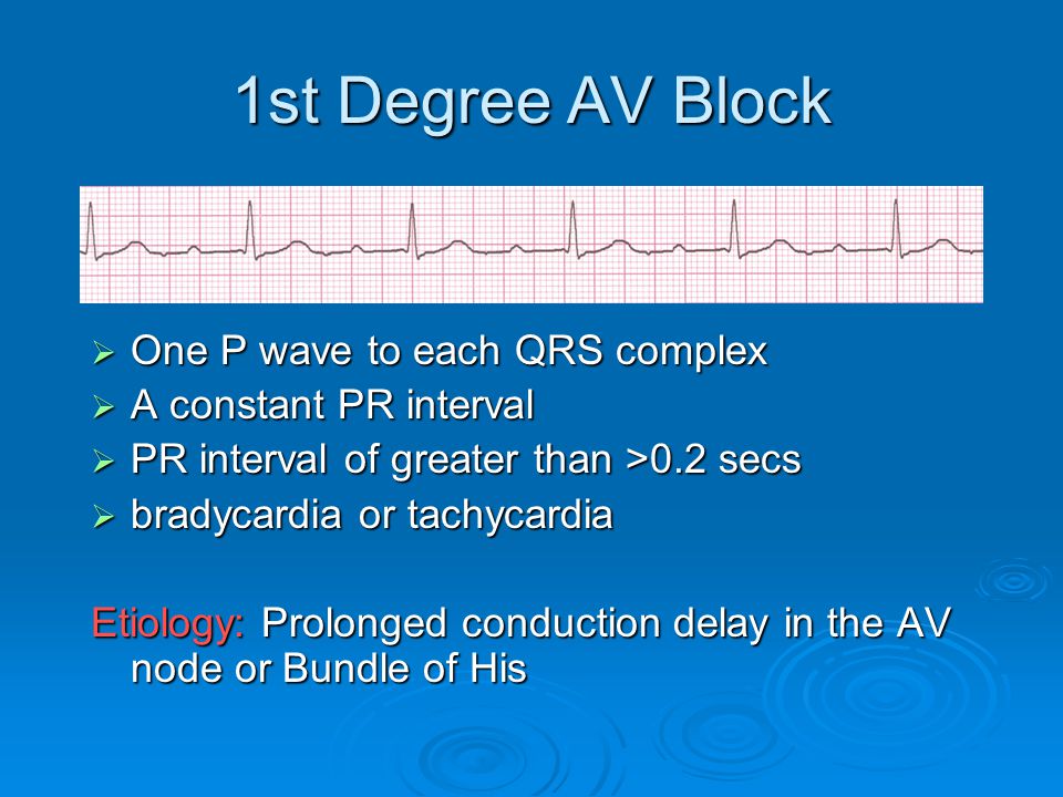 1st Degree AV Block One P wave to each QRS complex