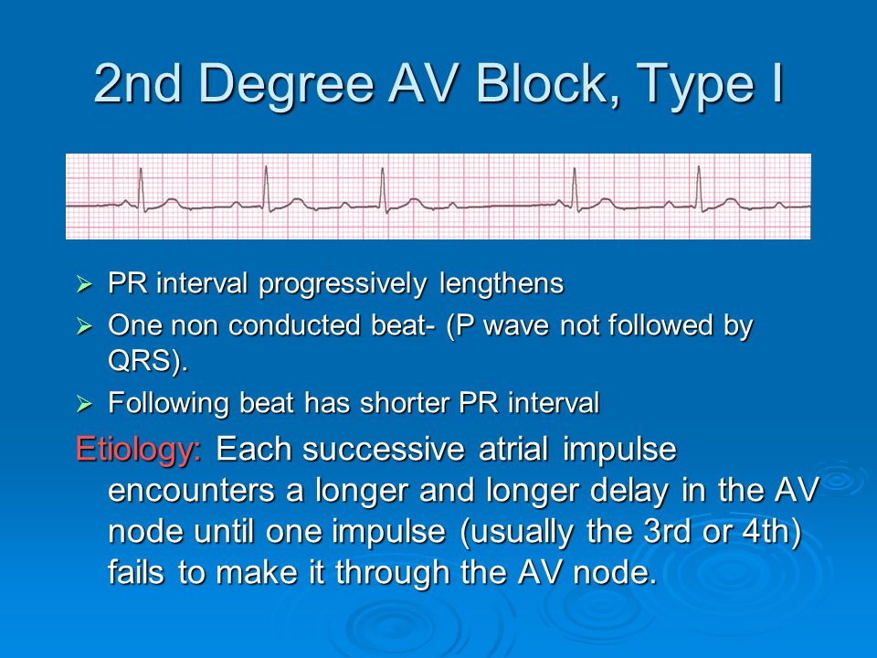 2nd Degree AV Block, Type I