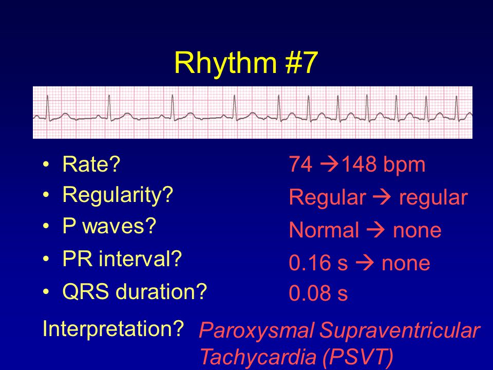 Rhythm #7 Rate 74 148 bpm Regularity Regular  regular P waves