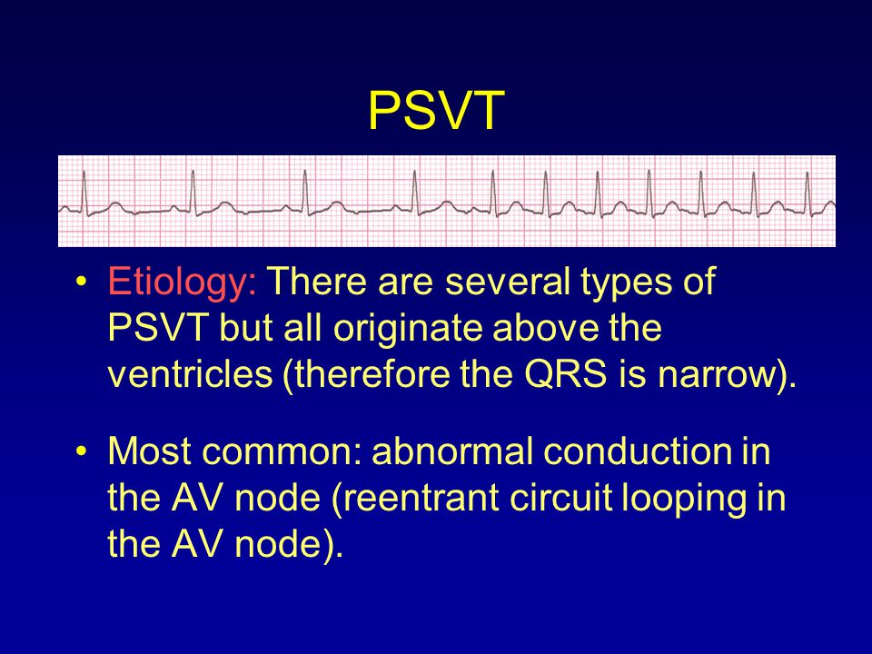 PSVT Etiology: There are several types of PSVT but all originate above the ventricles (therefore the QRS is narrow).
