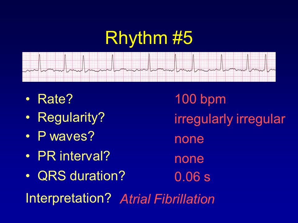 Rhythm #5 Rate 100 bpm Regularity irregularly irregular P waves
