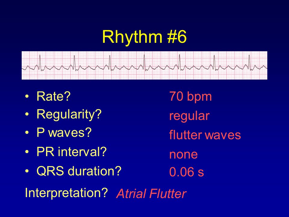 Rhythm #6 Rate 70 bpm Regularity regular P waves flutter waves