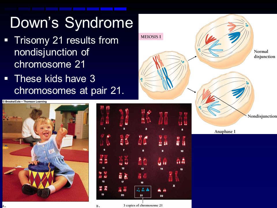 Down’s Syndrome Trisomy 21 results from nondisjunction of chromosome 21.