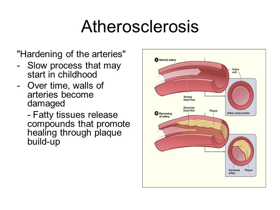Atherosclerosis Hardening of the arteries