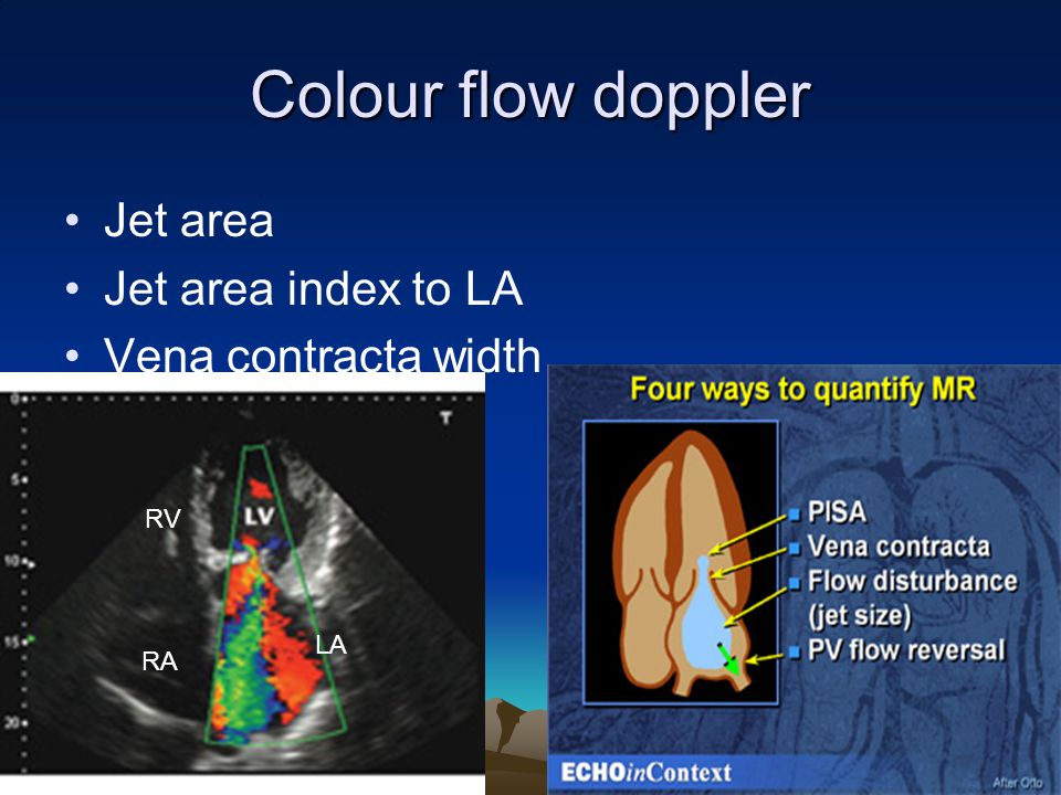 Colour flow doppler Jet area Jet area index to LA Vena contracta width