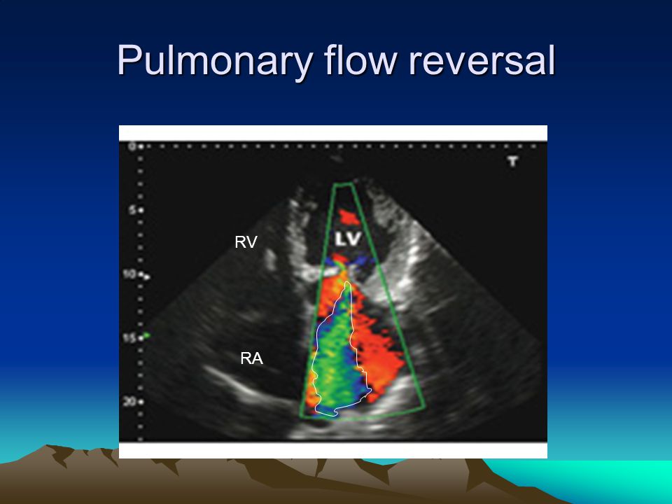 Pulmonary flow reversal