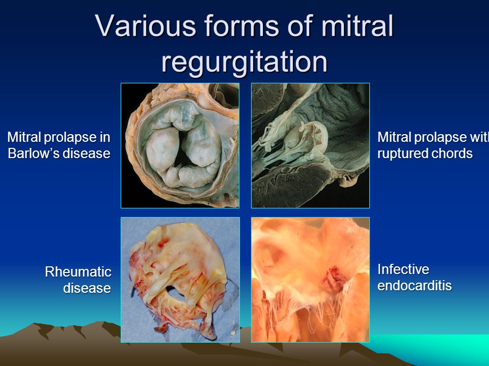 Various forms of mitral regurgitation