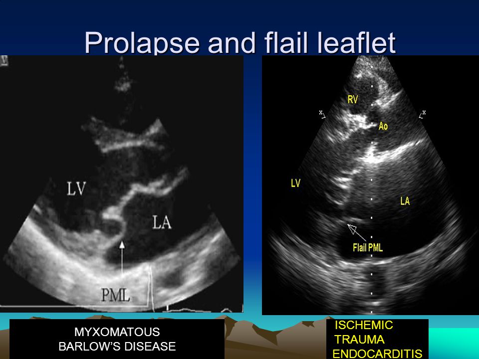 Prolapse and flail leaflet