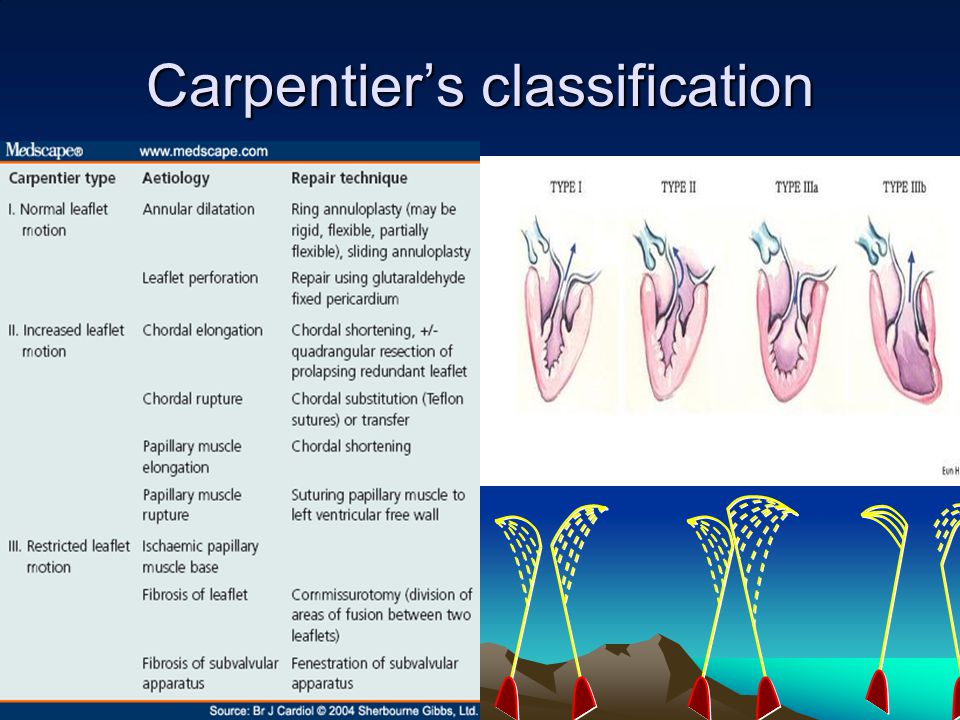 Carpentier’s classification