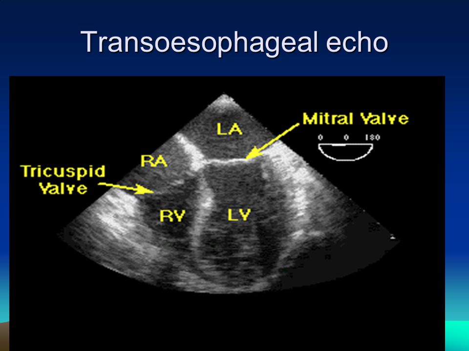 Transoesophageal echo