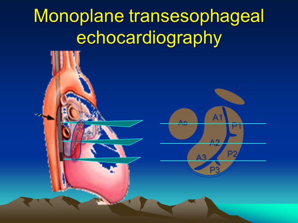 Monoplane transesophageal echocardiography