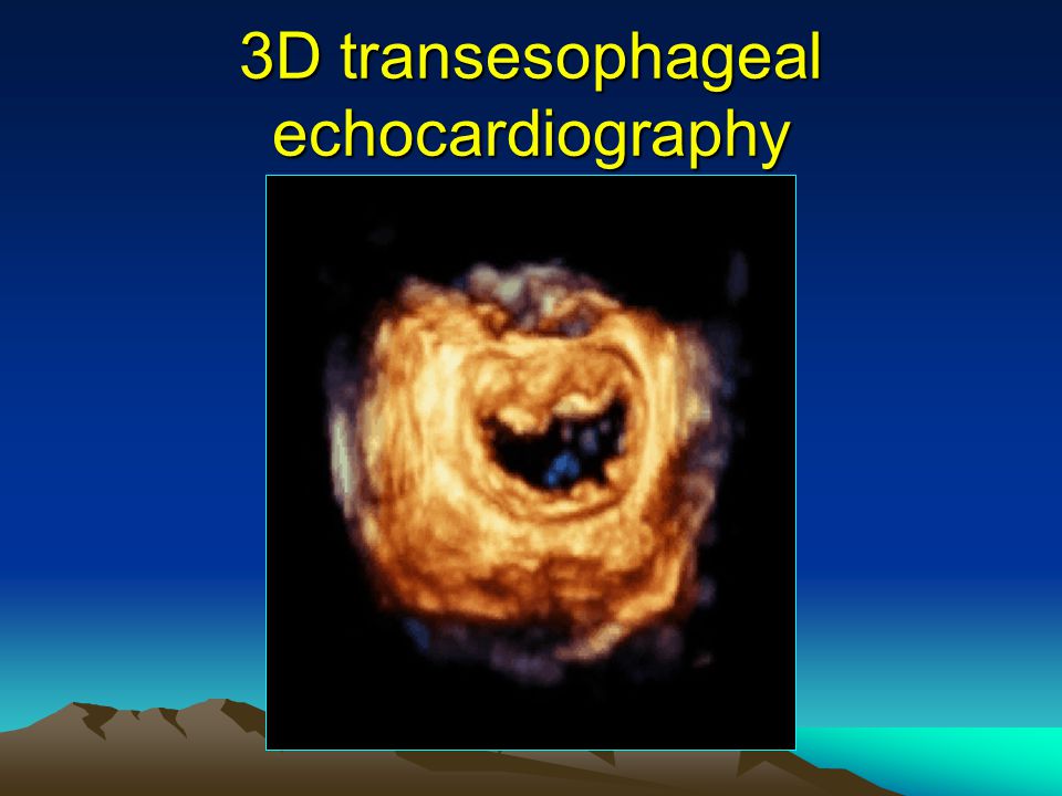 3D transesophageal echocardiography