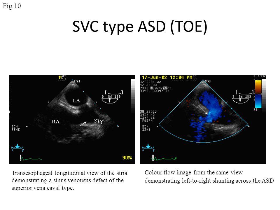 Fig 10 SVC type ASD (TOE) LA. RA. SVC. Transesophageal longitudinal view of the atria. demonstrating a sinus venousus defect of the.