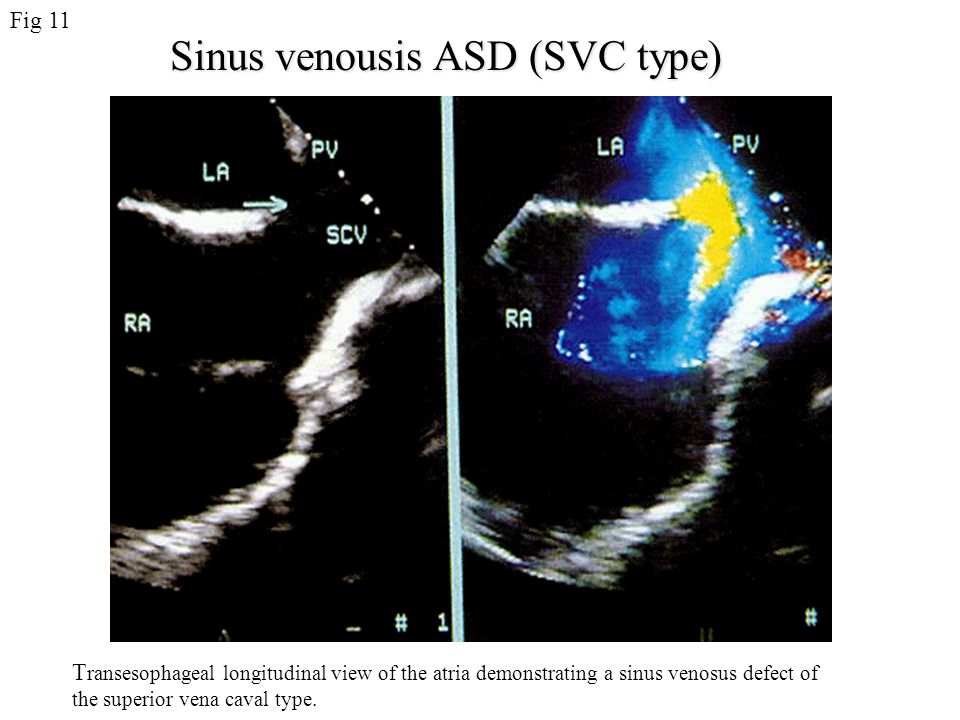 Sinus venousis ASD (SVC type)