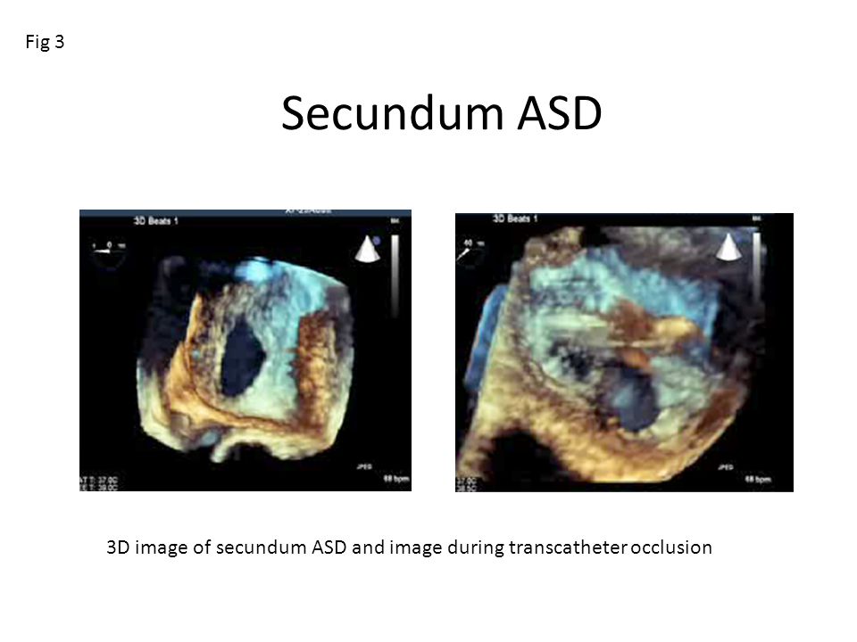 Fig 3 Secundum ASD 3D image of secundum ASD and image during transcatheter occlusion
