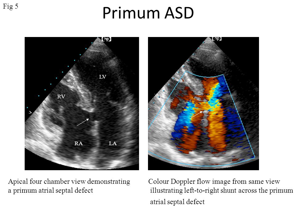 Primum ASD Fig 5 Apical four chamber view demonstrating
